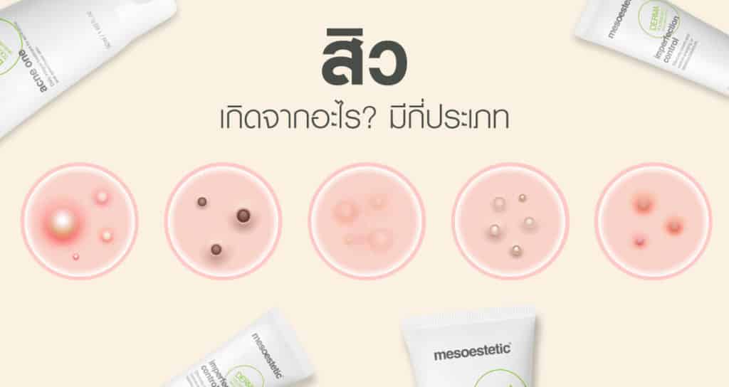 สิวเกิดจากอะไร มีกี่ประเภท
