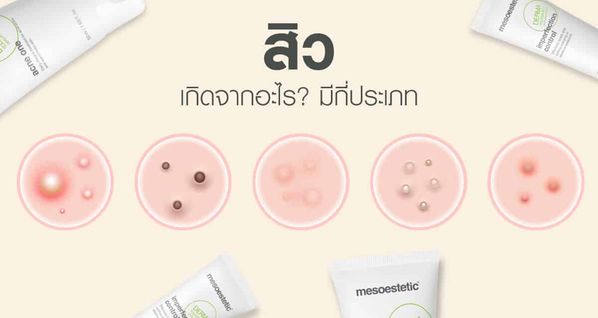 สิวเกิดจากอะไร มีกี่ประเภท