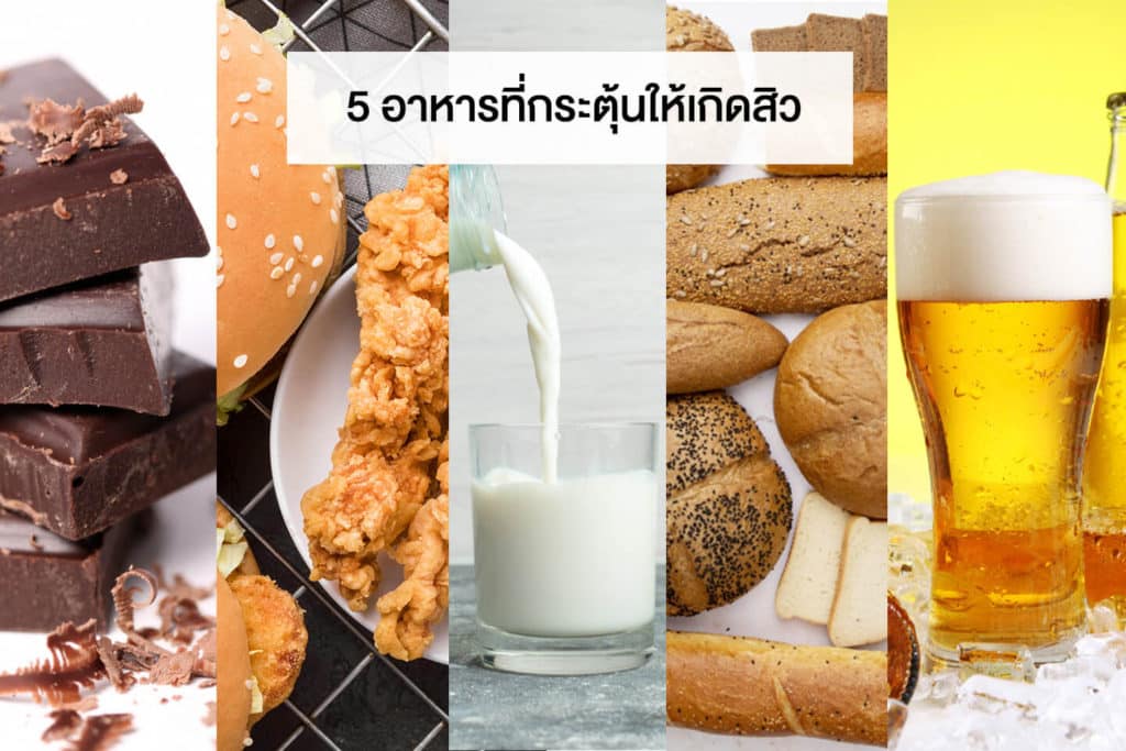5 อาหารที่กระตุ้นให้เกิดสิว