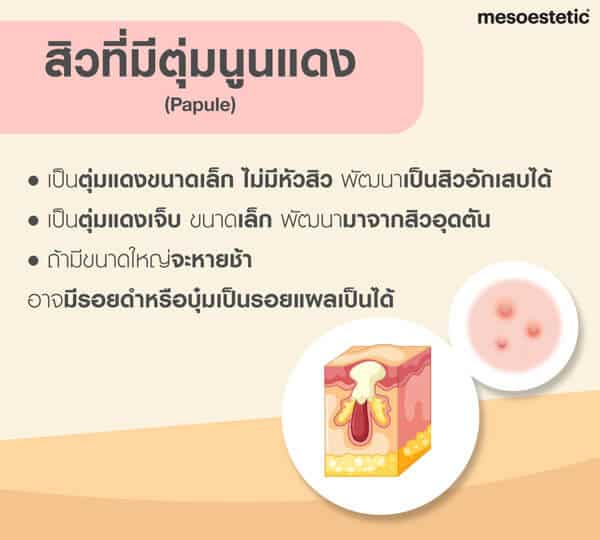 สิวตุ่มแดง