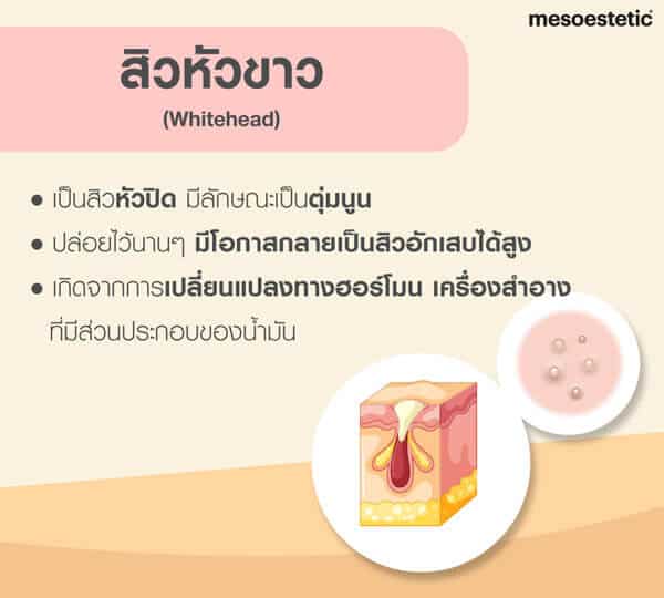 สิวหัวขาว