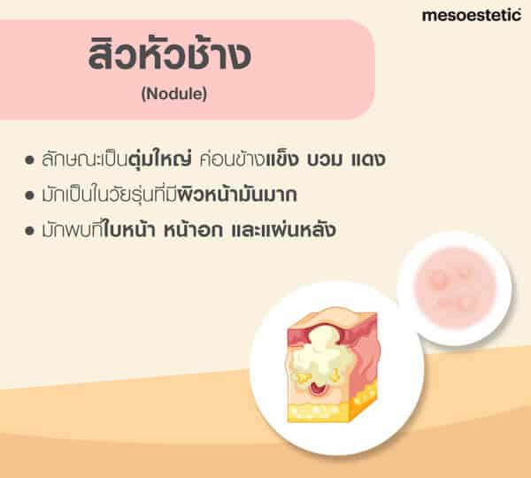 สิวหัวช้าง