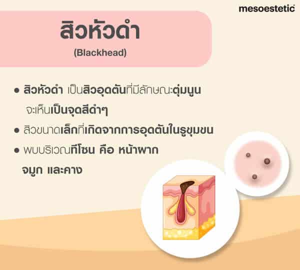 สิวหัวดำ