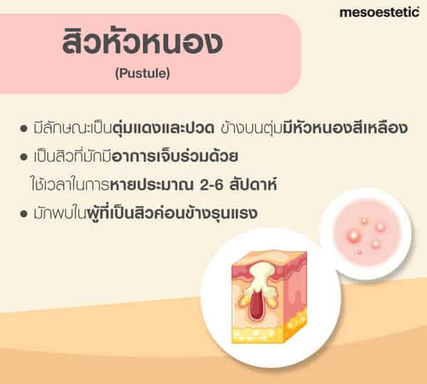 สิวหัวหนอง