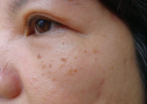 กระเนื้อ