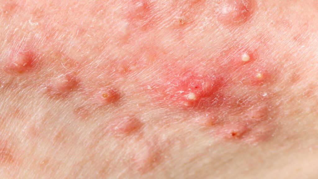 สิวหัวช้าง