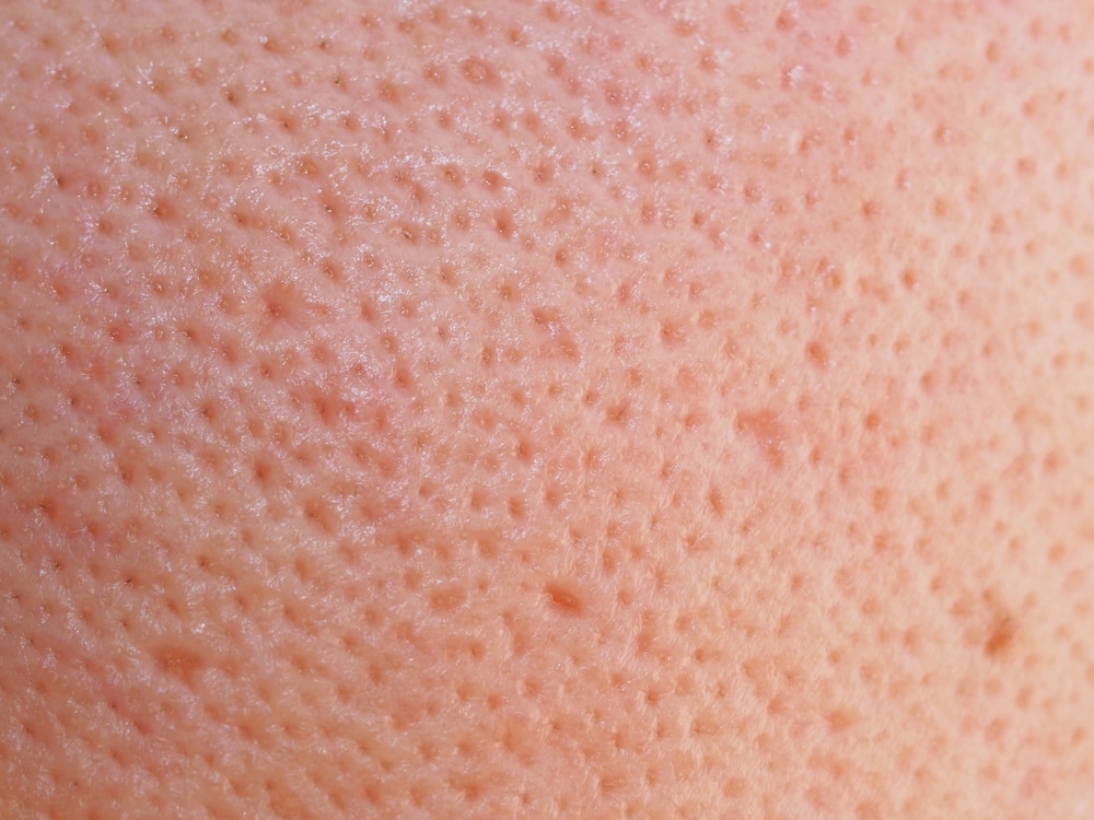 รูขุมขนกว้าง