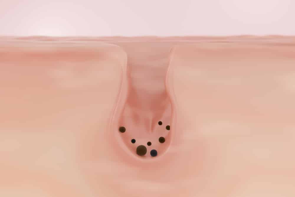 สิวหัวดำ