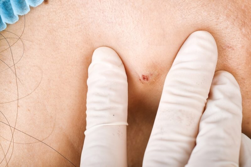 สิวหัวช้าง