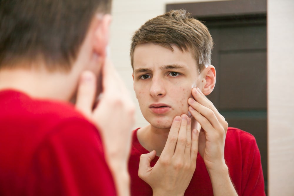 สิวฮอร์โมน