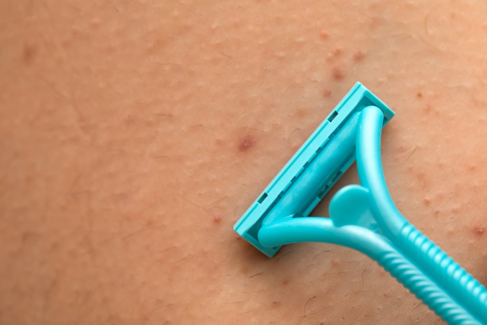 รูขุมขนอักเสบ