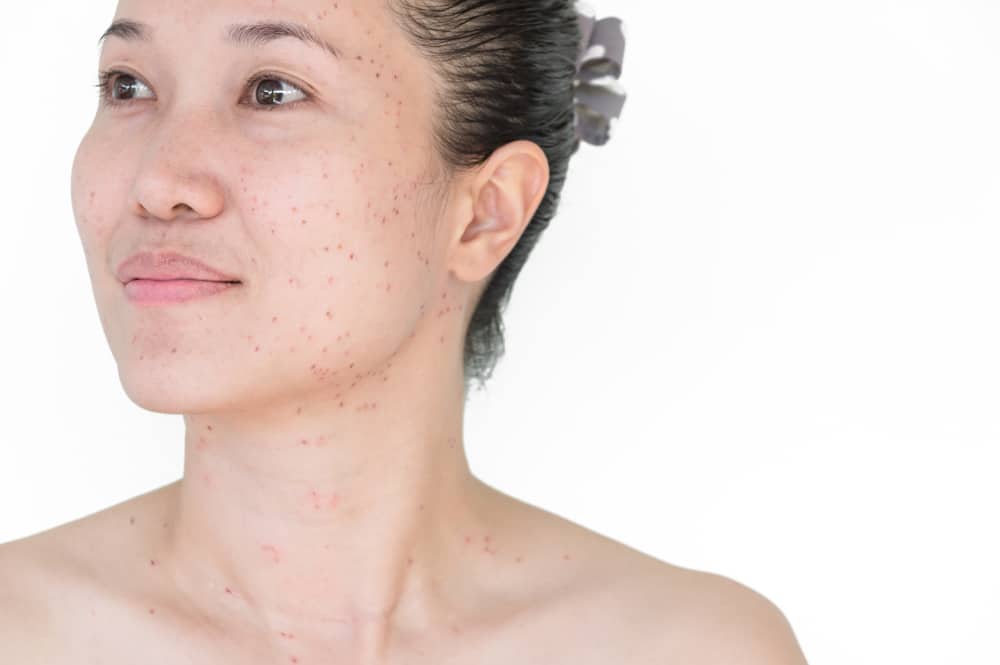 จุดด่างดำ คือ
