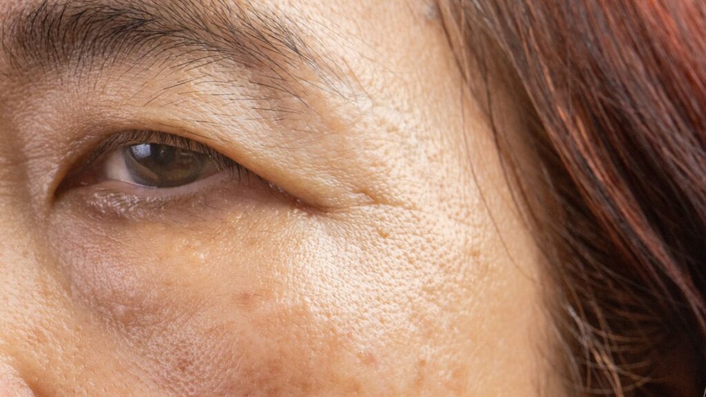 ลดริ้วรอย