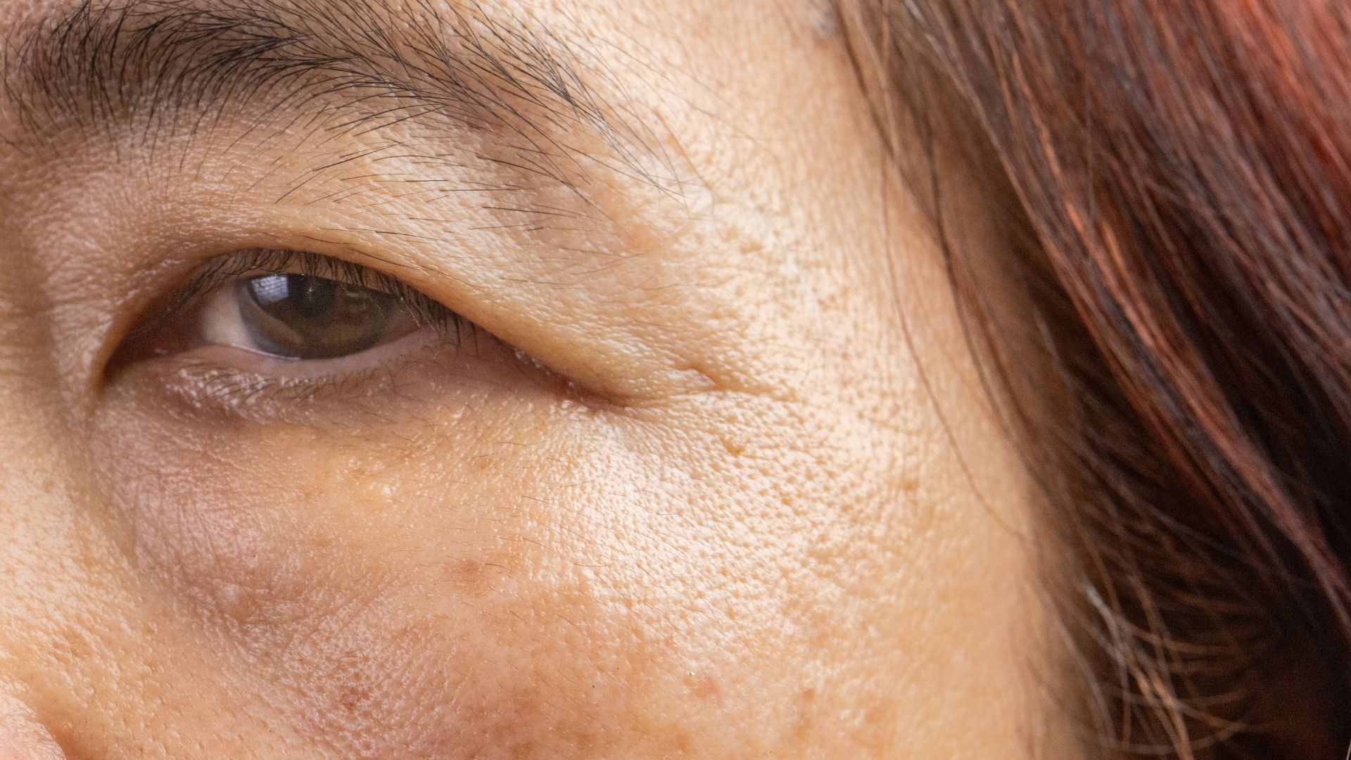 ลดริ้วรอย