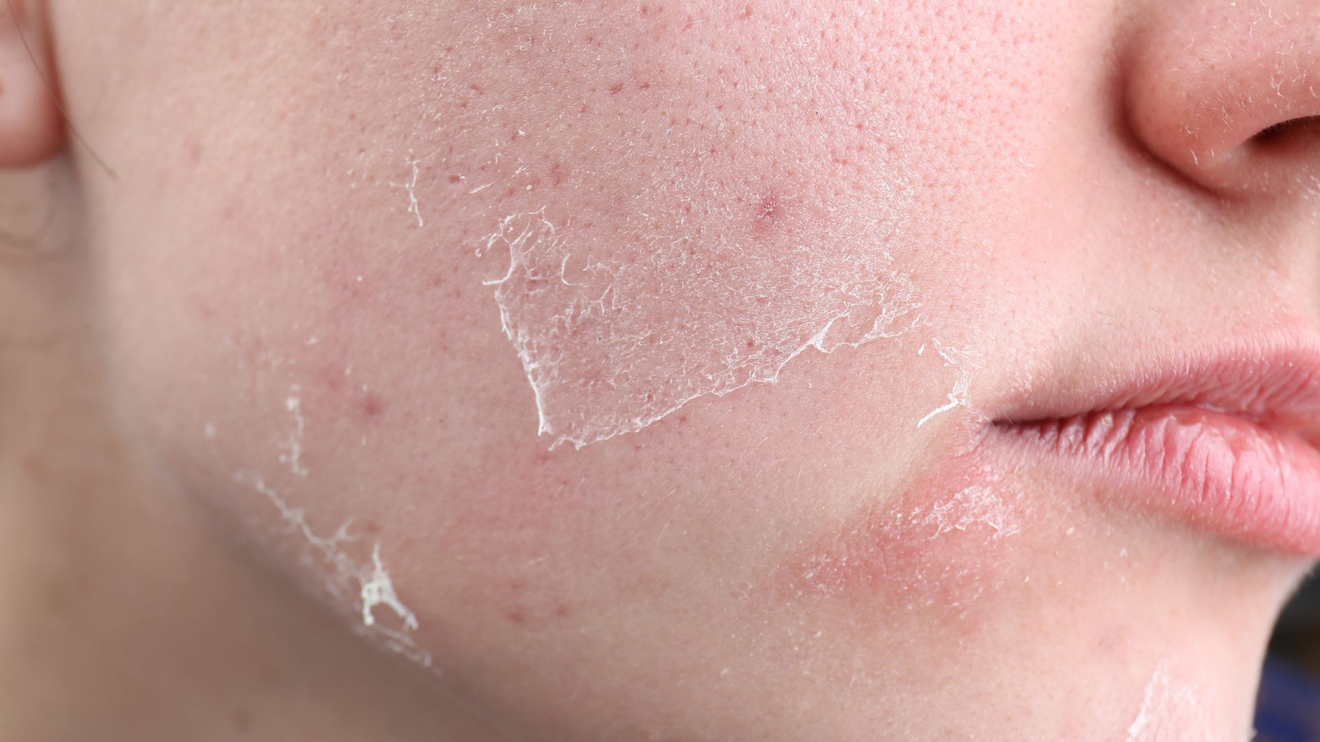 หน้าลอกเป็นขุย