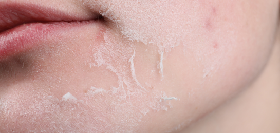 ผิวลอกเป็นขุย