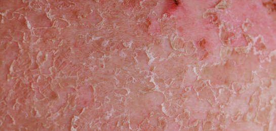 หน้าลอกเป็นขุย