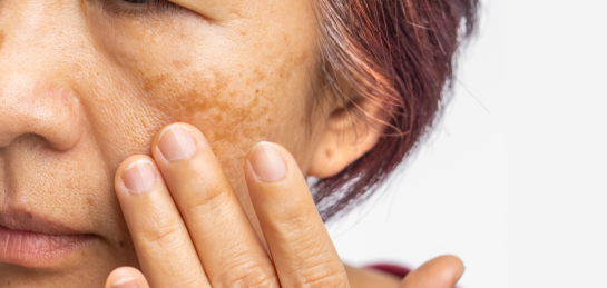 หน้าเป็นฝ้า