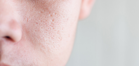 หน้ามัน