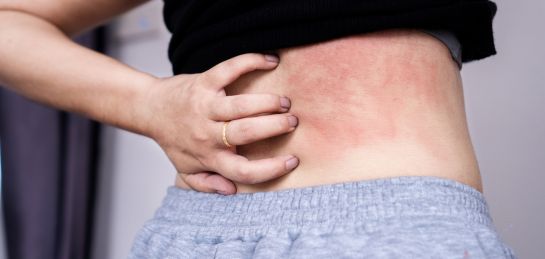 ผิวแห้งคัน