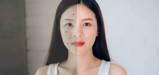 รอยดำจากสิว