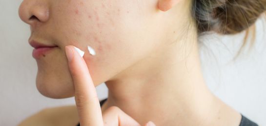 รอยดำจากสิว